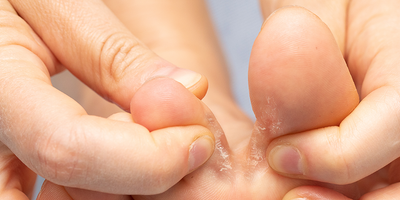 Funghi dei piedi: quali sono, come riconoscerli e trattarli