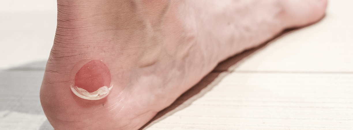 Vesciche ai Piedi e Scarpe Nuove Esperto del piede