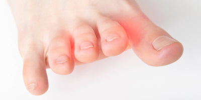 Il Neuroma di Morton: Cos’è, Sintomi e Cause