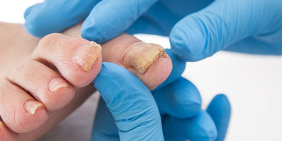 Onicodistrofia: un Disturbo delle Unghie Fragili