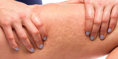 Calze a compressione graduata e cellulite: un rimedio o no?