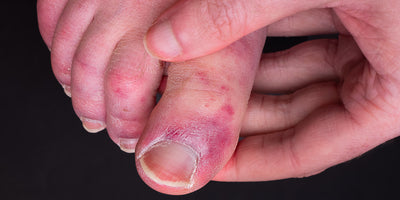 Geloni ai piedi: cosa sono, come riconoscerli e trattarli?