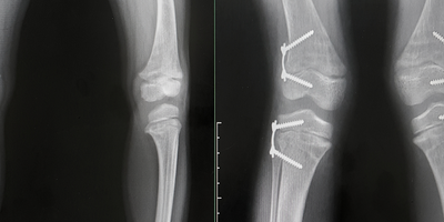 Ginocchio Varo e Valgo: cause e rimedi