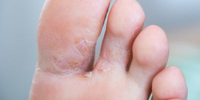 Igiene del piede, cattivi odori e infezioni