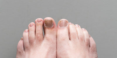 Stufo dei funghi alle unghie?