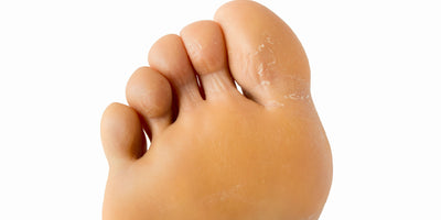 Rimuovere la pelle ispessita del piede