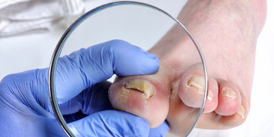 Infezioni delle unghie dei piedi: cosa devi sapere