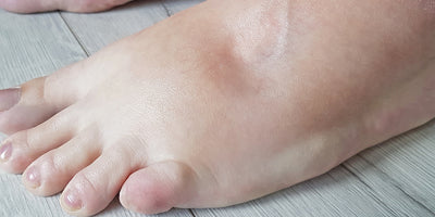 Piedi gonfi, caldo, estate: tutto quello che devi sapere