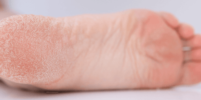 Piedi secchi, screpolati, che si spellano: cosa fare?
