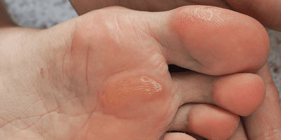 Tipi di calli: quali sono e come riconoscerli